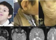 3 Agustus Diperingati sebagai Hari Kesadaran CLOVES Syndrome, Ini Penjelasannya