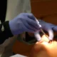 Mengenal Sariawan: Penyebab, Jenis, dan Upaya Pencegahan